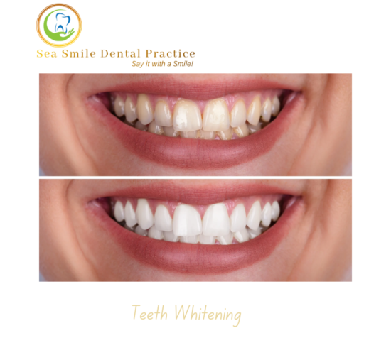 Teeth Whitening