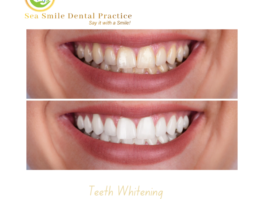 Teeth Whitening
