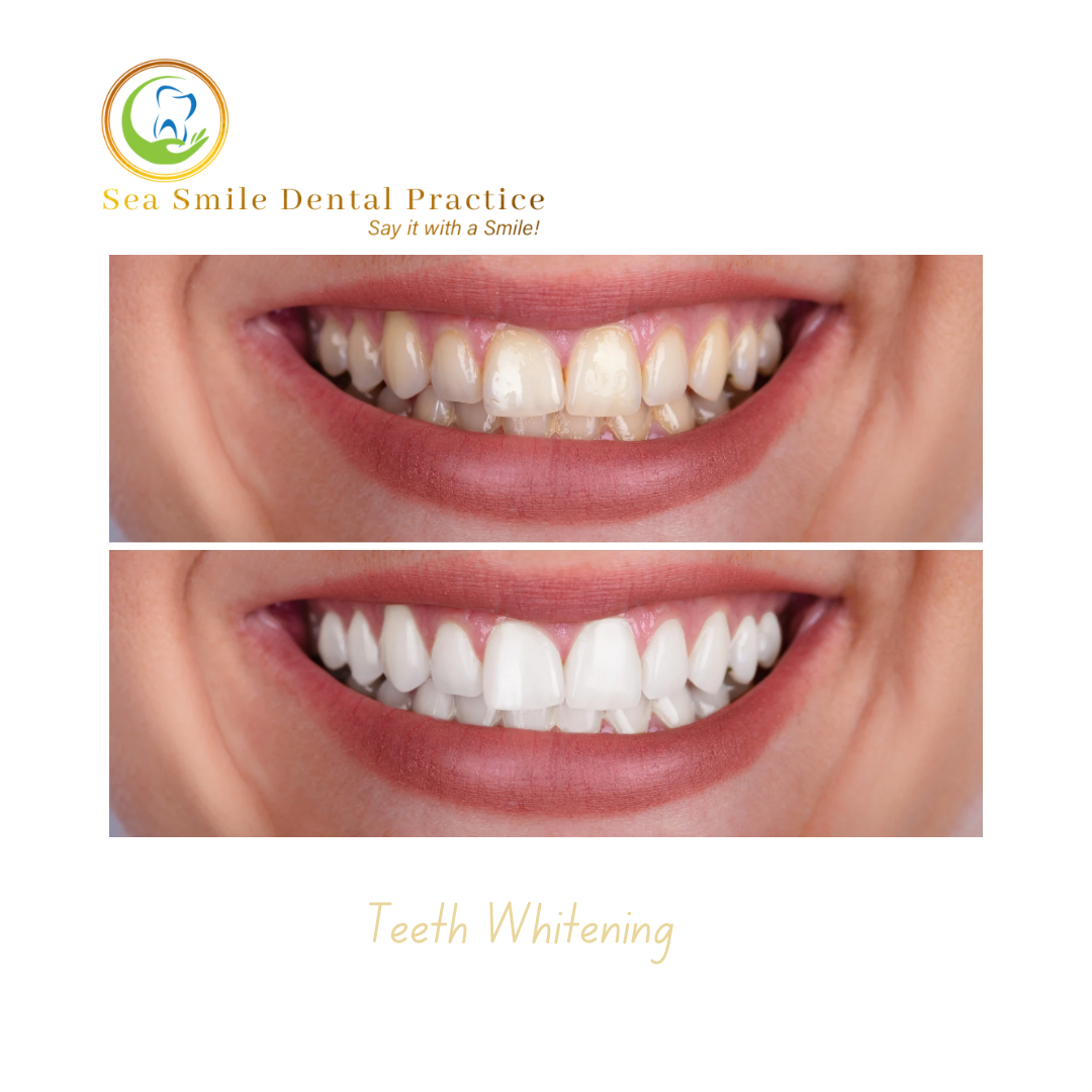 Teeth Whitening