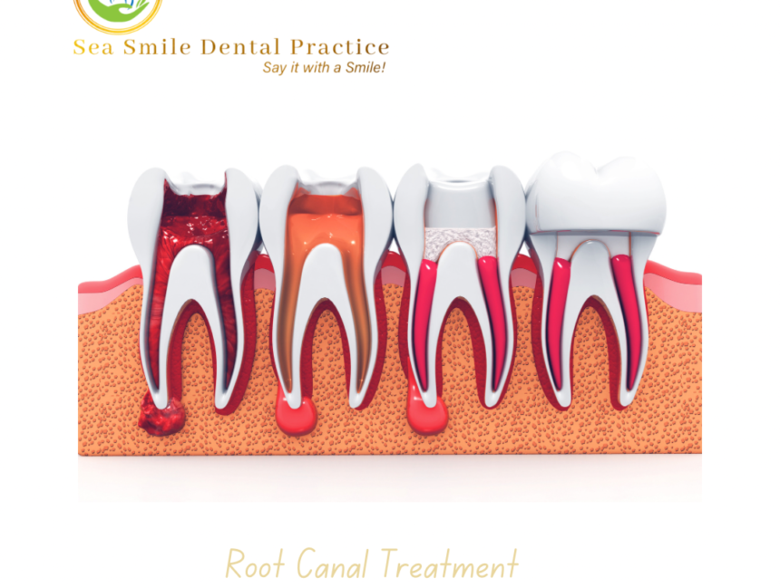 Root Canal